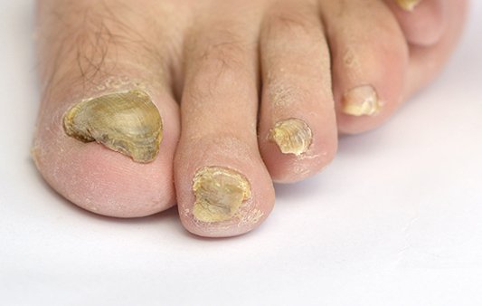 Thick Toenails | Clinical Blog | ACE Feet in Motion Thick Toenails | Clinical Blog | ACE Feet in Motion